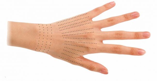 Lugares de inyección para manos durante la biorevitalización.