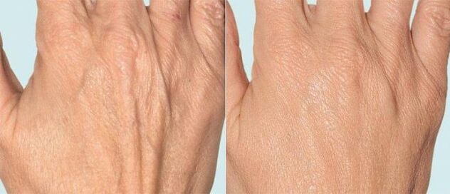 Piel de las manos antes y después de la terapia fraccionada.