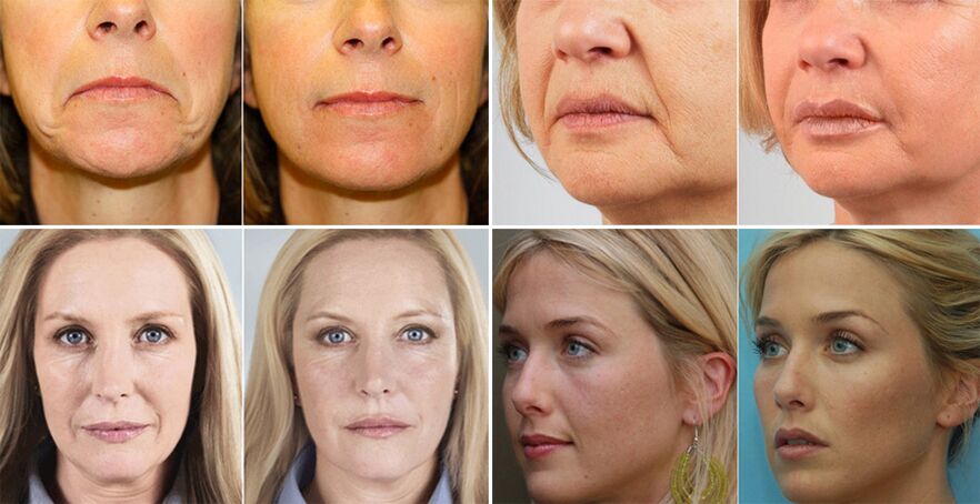 fotos de mujeres antes y después del rejuvenecimiento de la piel del rostro