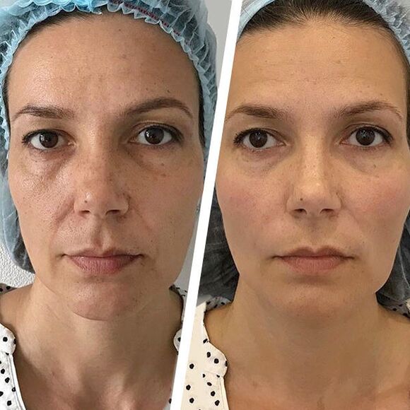 fotos de la cara antes y después del rejuvenecimiento con láser